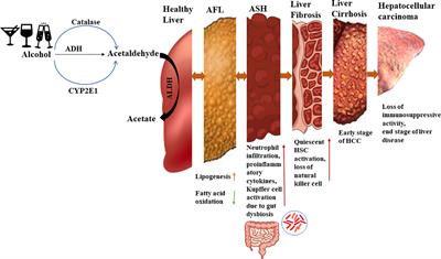 Stress mechanism involved in the progression of alcoholic liver disease and the therapeutic efficacy of nanoparticles